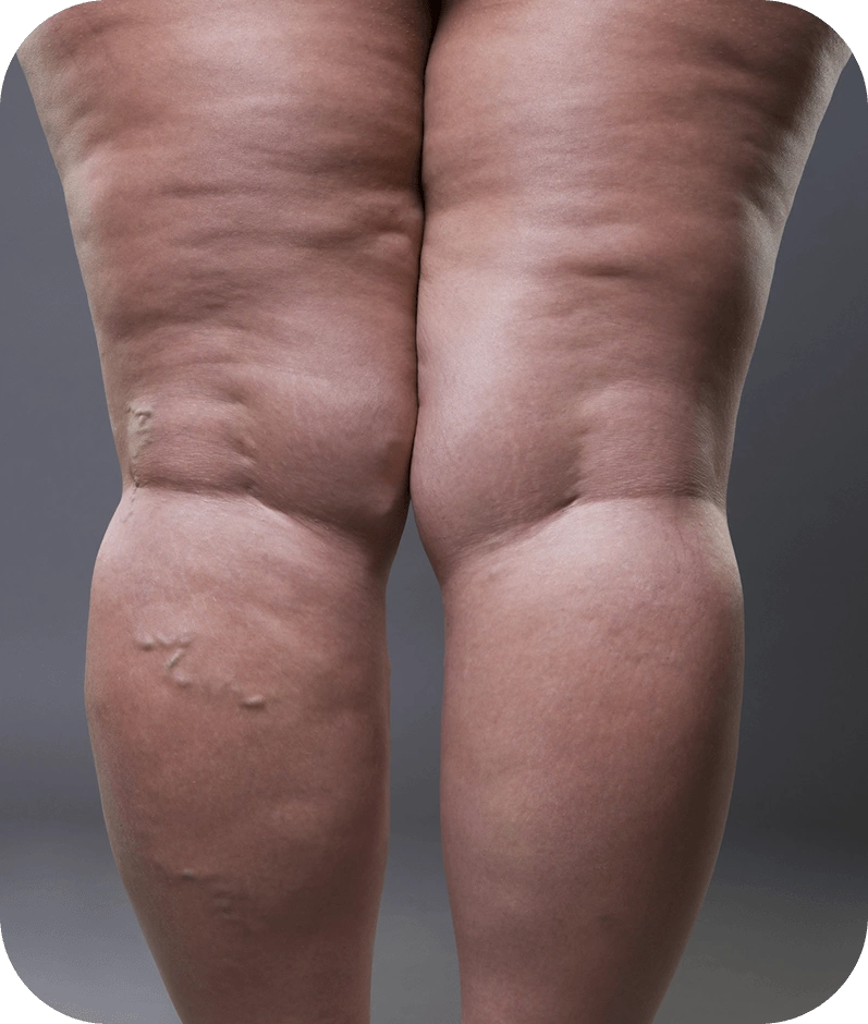 Tratamento para Obesidade, Emagrecimento e Lipedema